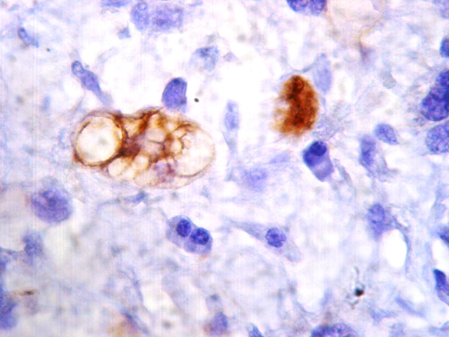 Lipoblastos tumorales en phyllodes maligno - <div style=